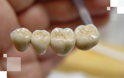 Установка металлокерамических коронок у частного стоматолога в Киеве