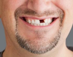 Потеря зубов: находитесь ли вы в группе риска?