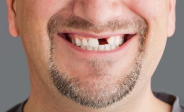 Втрата зубів: чи перебуваєте ви у групі ризику?
