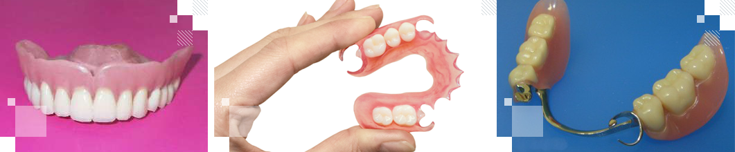 Съемные зубные протезы: разновидности